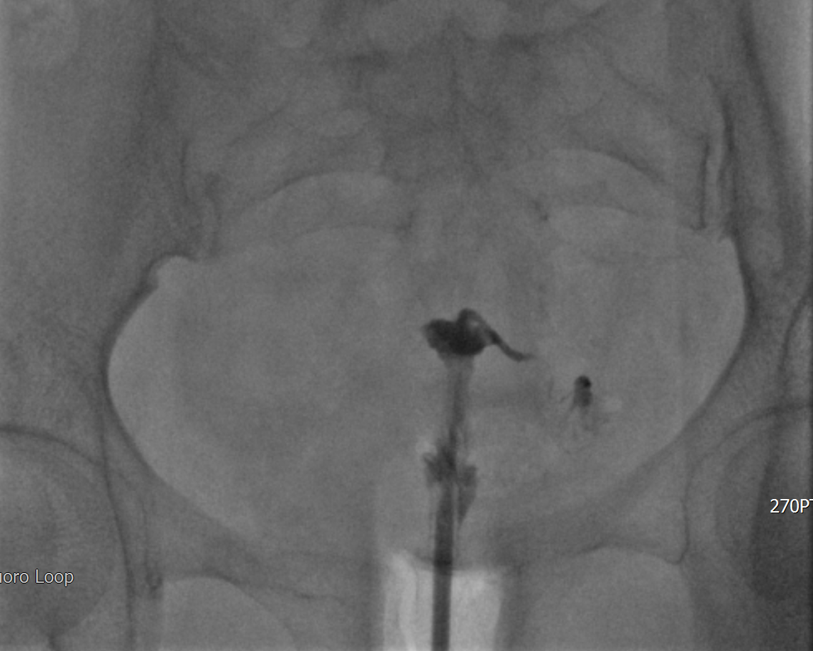 【放射科】放射科成功完成我院第一例输卵管介入栓塞术