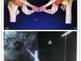 [骨科]骨二科开展多学科合作（multidisciplinary diagonosis and treatment pattern，MDT）为老年骨折患者保驾护航