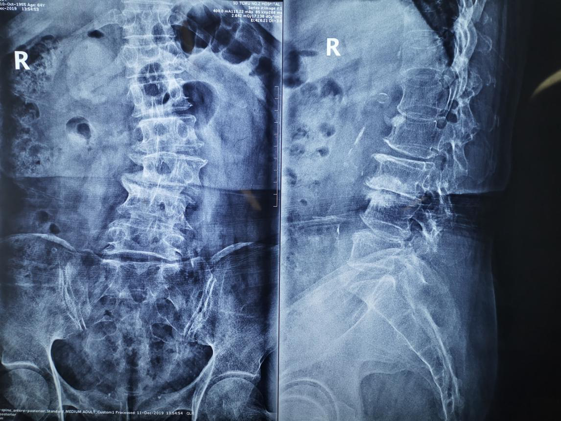 【骨二科】我院骨二科董建文团队完成一例高难度复杂脊柱手术