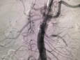 【放射科】放射科成功开展我院第一例肾动脉支架植入术