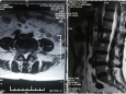 【骨科】开展新手术技术：显微镜辅助通道下神经减压融合+经皮螺钉固定术(MIS-TLIF)治疗腰椎间盘突出伴不稳症