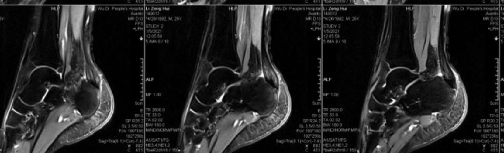 骨伤科二病区完成多例复杂足踝澳门新葡亰手机版手术