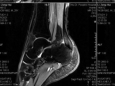 骨伤科二病区完成多例复杂足踝外科手术