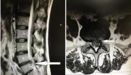 【骨科】脊柱骨科“无微不治”，UBE技术消除患者腰腿痛困扰