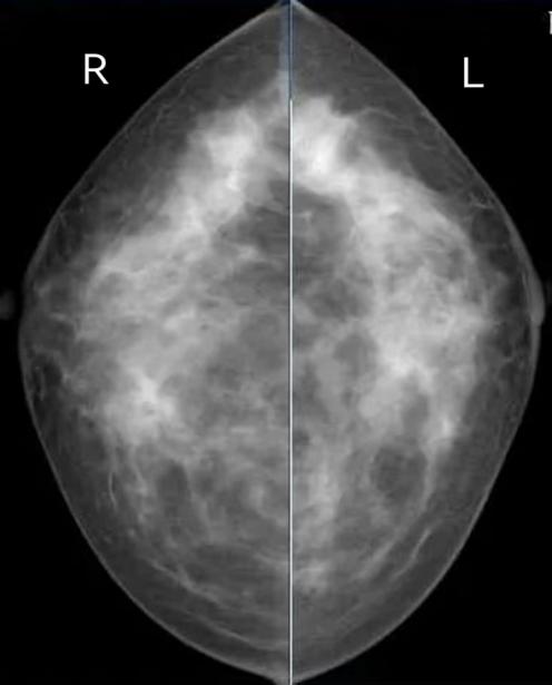 【放射科】助力“两癌”筛查，浅谈乳腺钼靶检查