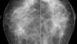 【放射科】助力“两癌”筛查，浅谈乳腺钼靶检查