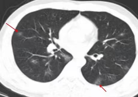【放射科】带您了解新型冠状病毒感染的胸部CT表现