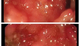我院消化中心进行粪菌移植治疗顽固性溃疡性结肠炎公益免费援助项目
