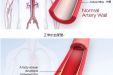 【脑病科】一文读懂动脉粥样硬化