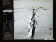 【神经外科】颈动脉支架置入术病例汇报