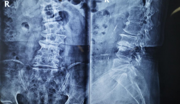 【骨二科】我院骨二科董建文团队完成一例高难度复杂脊柱手术