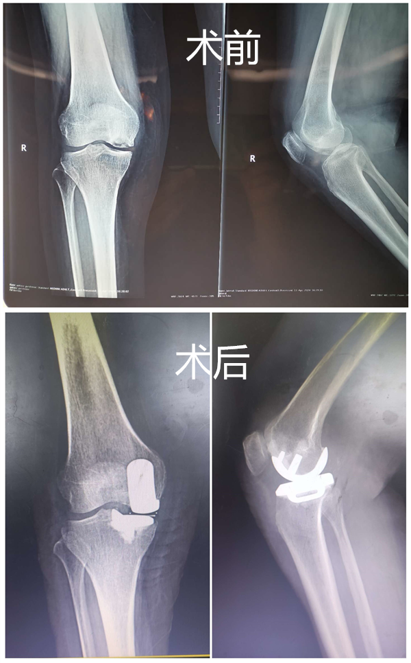 【骨伤科】骨二科开展膝关节单髁置换术