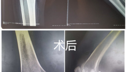 【骨伤科】骨二科开展膝关节单髁置换术