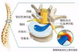 【骨伤科】腰椎间盘突出症的阶梯治疗