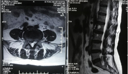【骨科】开展新手术技术：显微镜辅助通道下神经减压融合+经皮螺钉固定术(MIS-TLIF)治疗腰椎间盘突出伴不稳症