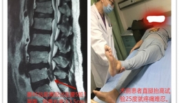 【神经外科疼痛科】7毫米内镜解决了突出大问题