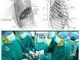 【胸心外科】小孔之光——我院胸腔镜微创手术进展