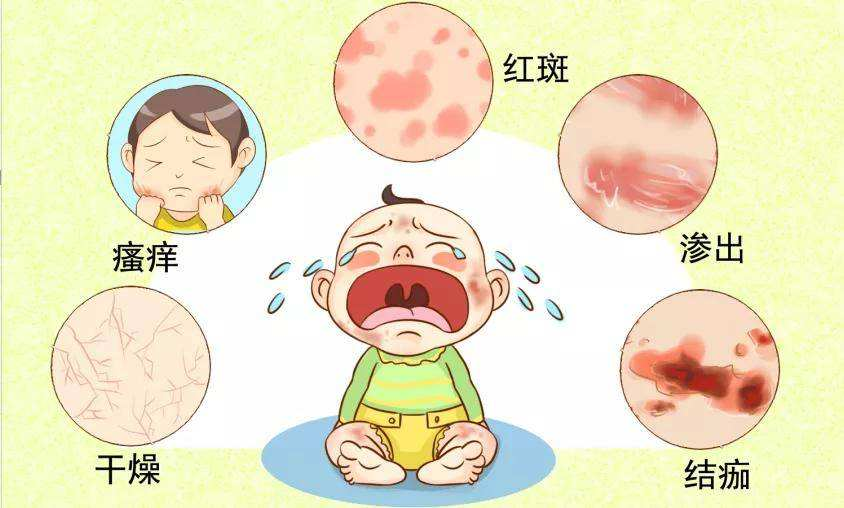 【医疗美容科】宝宝易被湿疹扰，科学防护要做好!