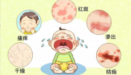 【医疗美容科】宝宝易被湿疹扰，科学防护要做好!