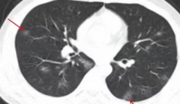 【放射科】带您了解新型冠状病毒感染的胸部CT表现