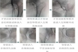 【放射科】股骨头介入治疗新技巧