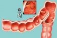 【消化中心内镜诊疗科】肠息肉科普——探秘肠道的奇妙花园