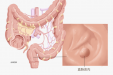肠息肉要不要切除