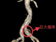 “拆弹专家”，护您周全 ——我院周围血管科成功开展一例髂动脉瘤介入治疗