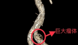 “拆弹专家”，护您周全 ——我院周围血管科成功开展一例髂动脉瘤介入治疗