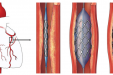 冠心病支架术后，定期复查都查啥？