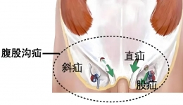 勿以疝小而不治，带你认识腹股沟疝