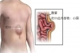 勿以疝小而不治，带你了解切口疝