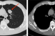 一起解读胸部CT报告