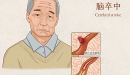 远离脑卒中，健康新生活