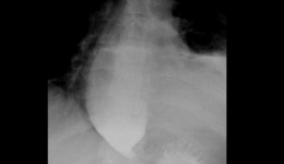打通生命通道-消化中心为贲门失弛缓患者行内镜微创POME手术