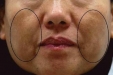 认识黄褐斑
