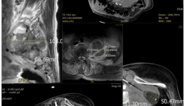 骨肉瘤知识科普