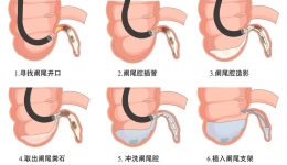 消化中心开展内镜下逆行阑尾炎治疗术（ERAT）不开刀！不手术！