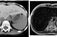 肝脏铁过载的影像学表现：带您了解“白肝”与“黑肝”